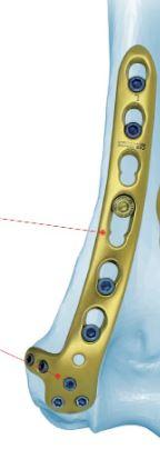 Дистальна латеральна плечова пластина, голівка 2.7мм ліва( Double Medical Technology Inc.)